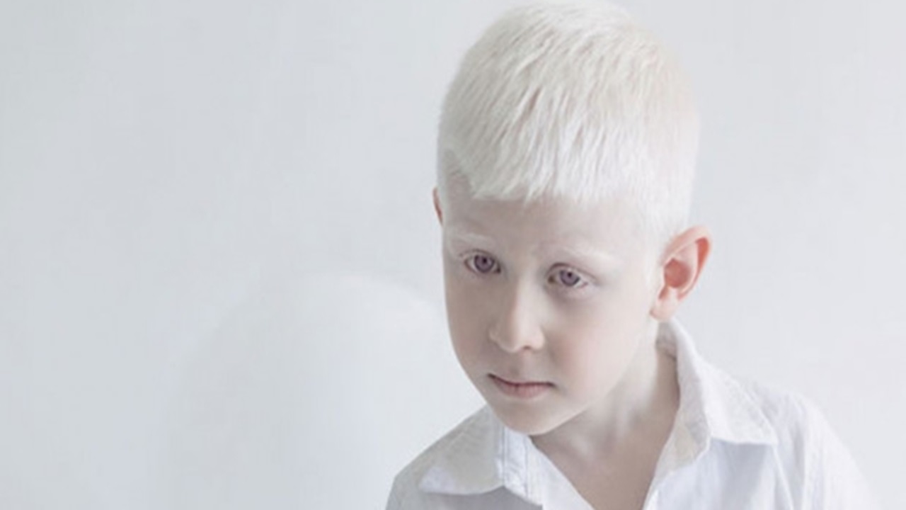 Albinizm (Albino) Nedir