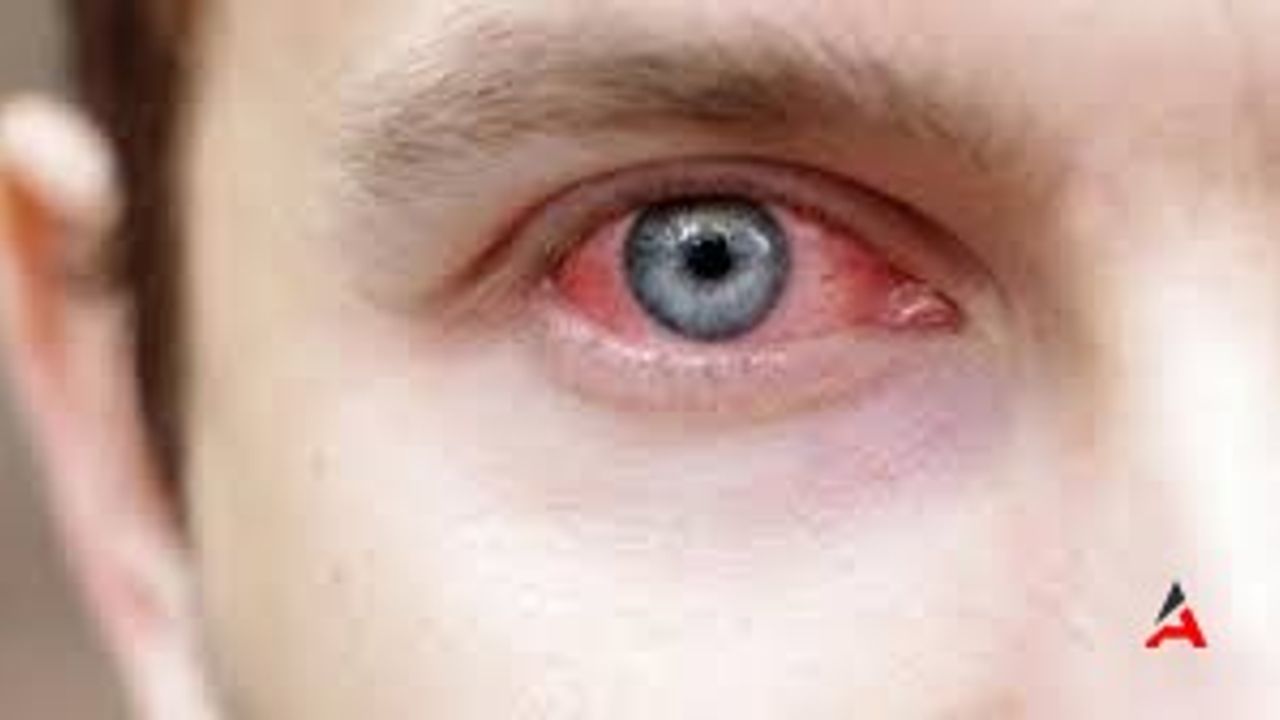 Göz Kızarmasının Ardındaki Gizem: Nedenler, Belirtiler ve Etkili Tedavi Yöntemleri!