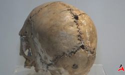 Dünyanın İlk Beyin Ameliyatına Ait Kafatası