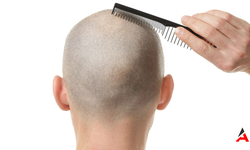 Erkeklerde Saç Dökülmesinin Nedeni Yer Çekimi Olabilir!