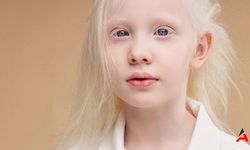 Albinizm (Albino) Nedir? Tedavisi Var Mıdır?