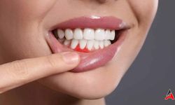 Diş Apsesi Nedir? Belirtileri ve Tedavisi