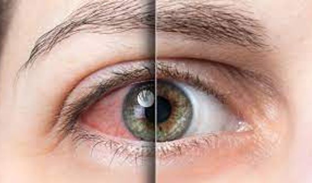 Göz Kanseri: Belirtileri Teşhis Yöntemleri ve Tedavi Seçenekleri