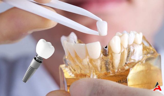 İstanbul'un En İyi Diş İmplant Doktorları